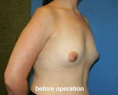 plastic-surgery-breast-augmentation